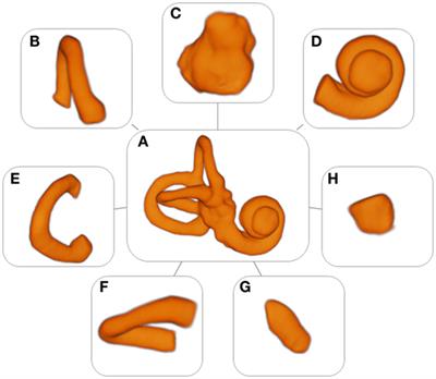 An Exploratory Study to Detect Ménière’s Disease in Conventional MRI Scans Using Radiomics